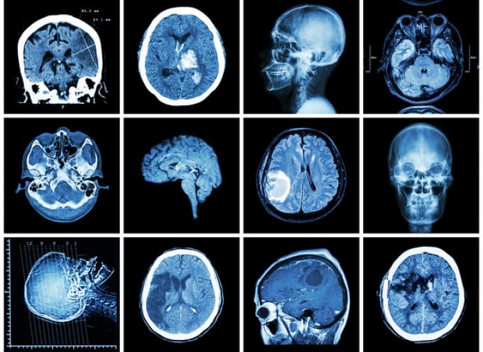 Neuroimaging in psichiatria (RMN, TAC, PET e SPECT)