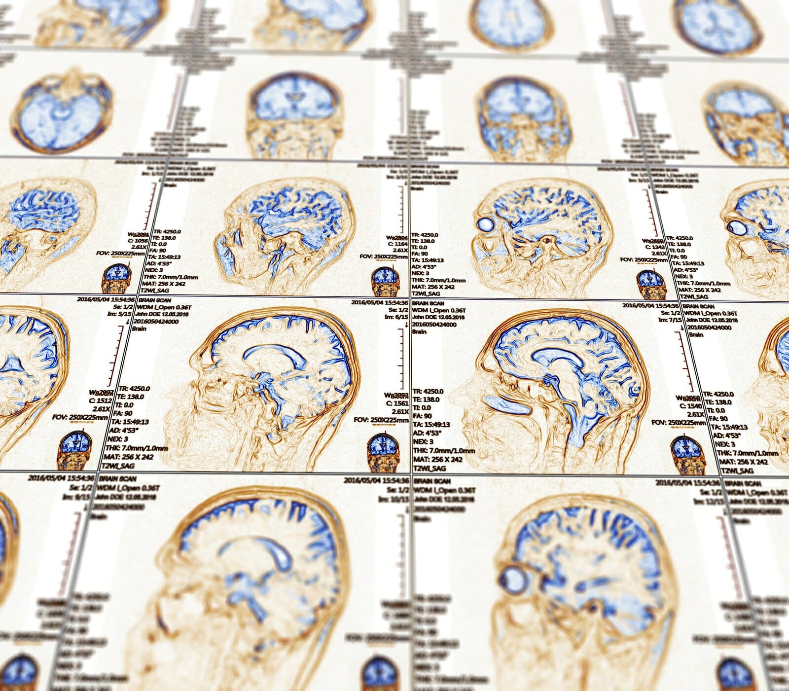 Depressione Resistente al Trattamento